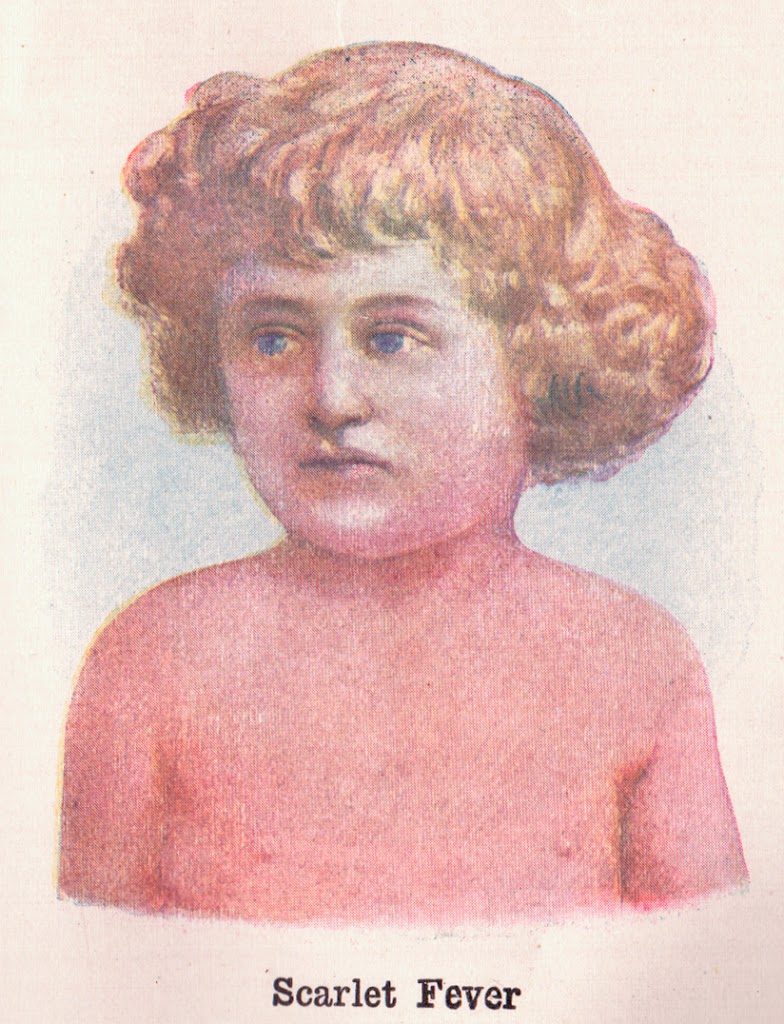 Acute nephritis in 1875